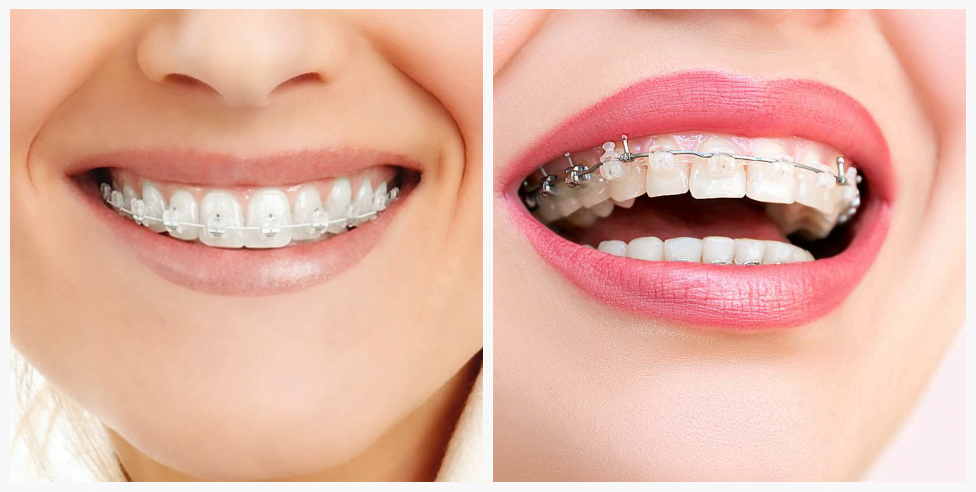 Чи можливо виправити неправильний прикус?