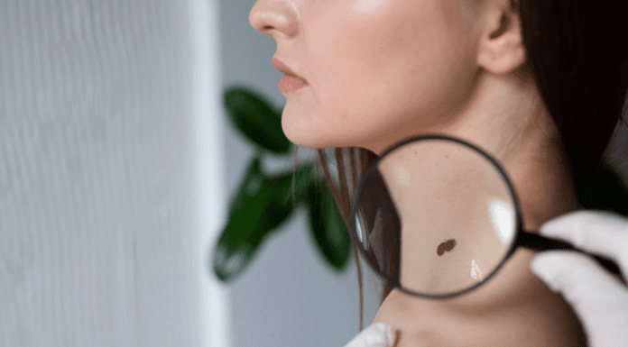 Обстеження та видалення невусів лазером в Одесі. Що варто знати про сучасну процедуру?